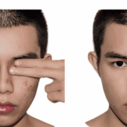 Anti-Acne Organic Facial Wash - For MEN-2